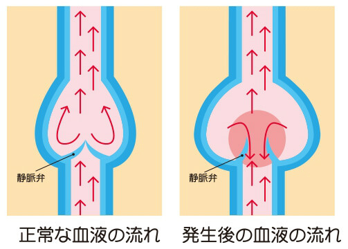 下肢静脈瘤の原因